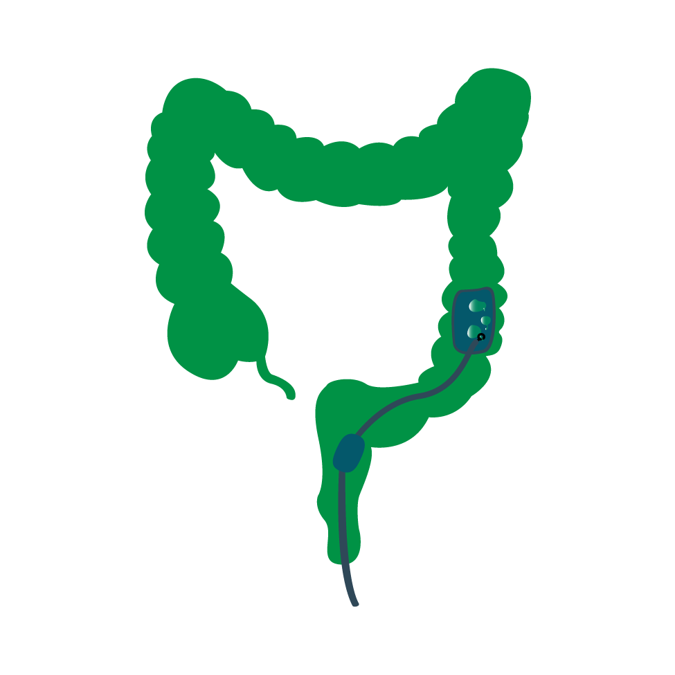 Colonoscopy and Polypectomy