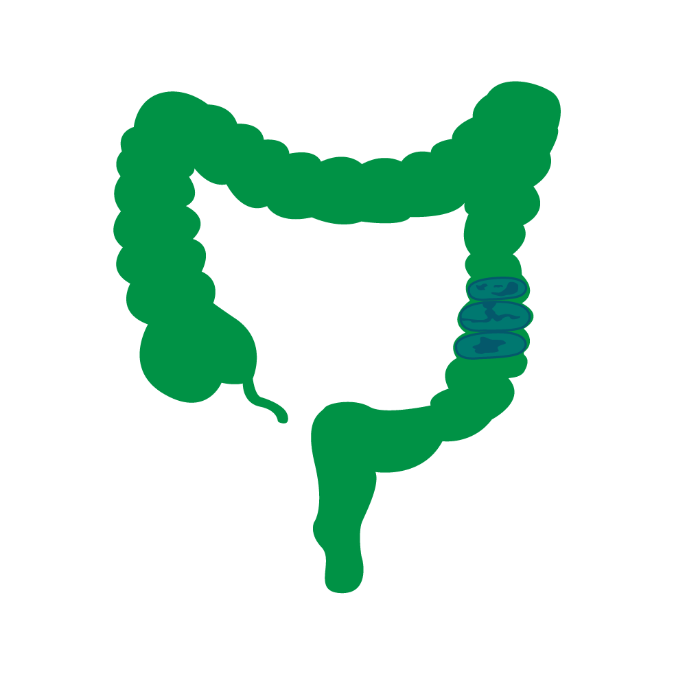 Ulcerative Colitis